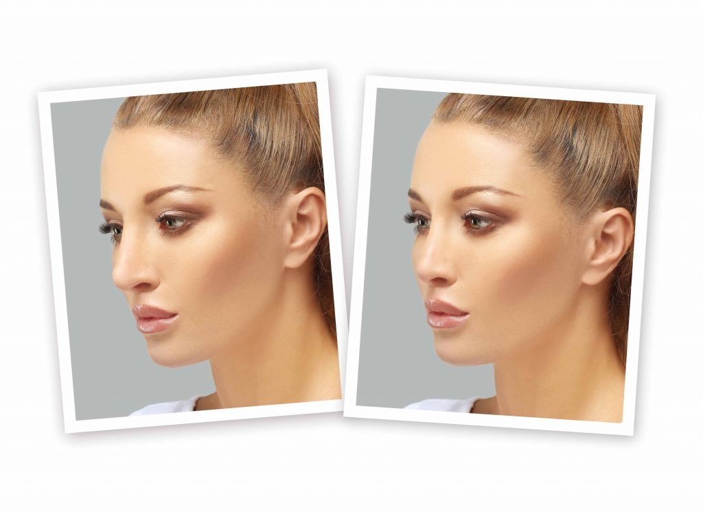 closed rhinoplasty before and after