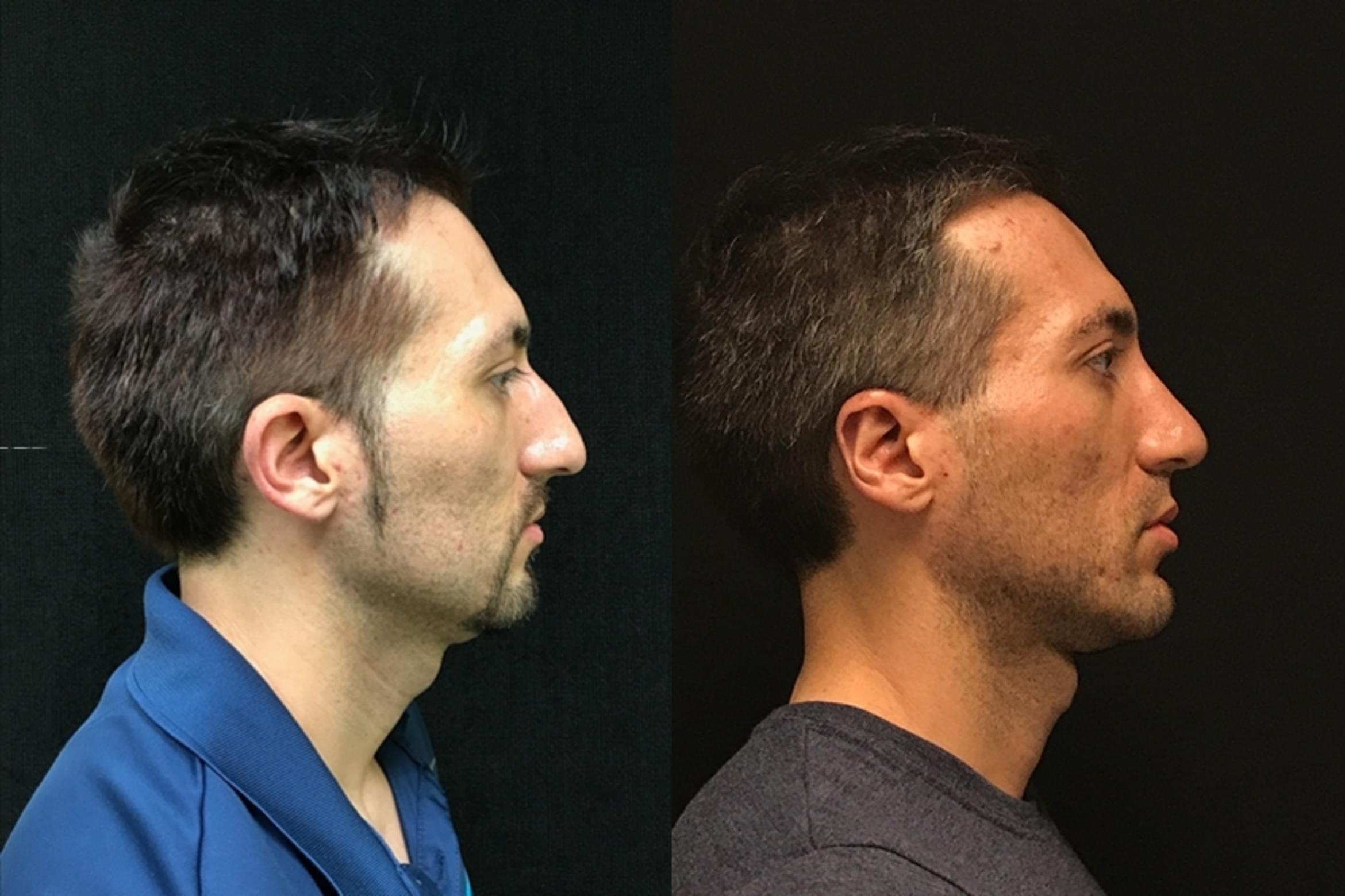 closed rhinoplasty before and after