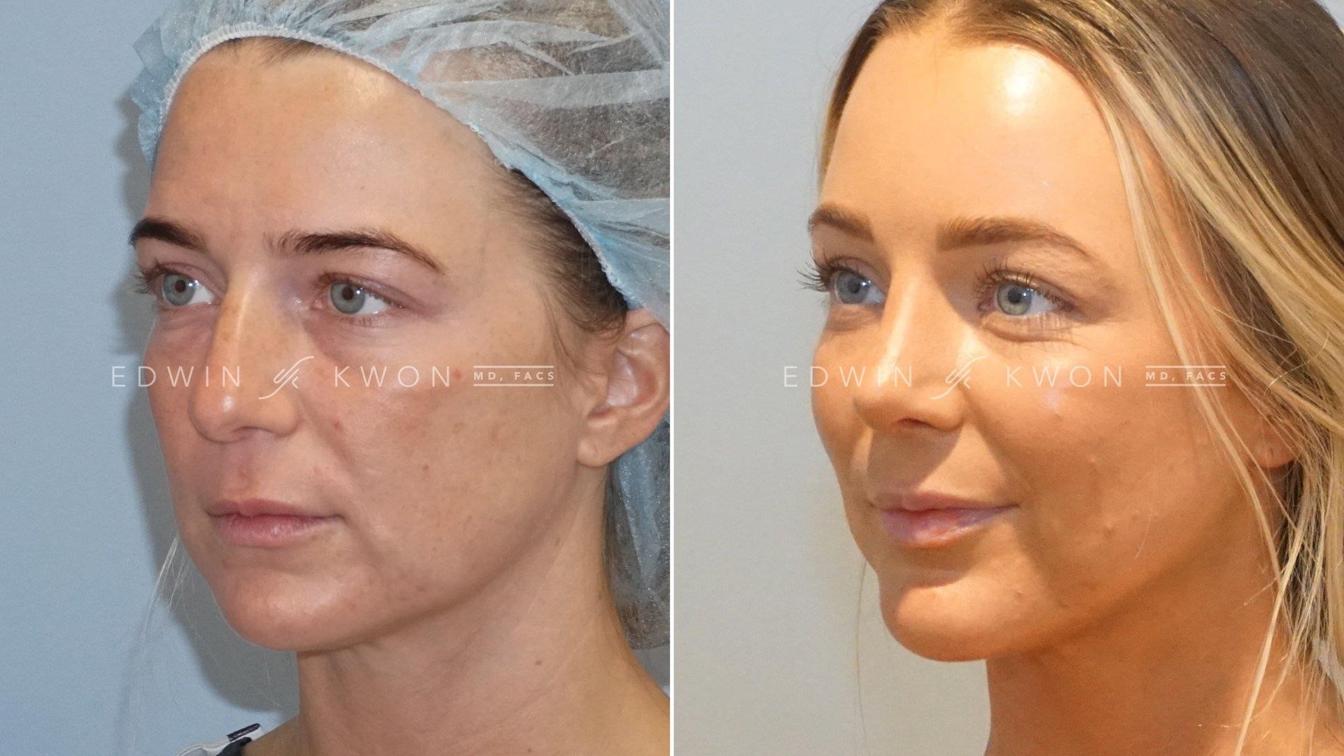 closed rhinoplasty recovery