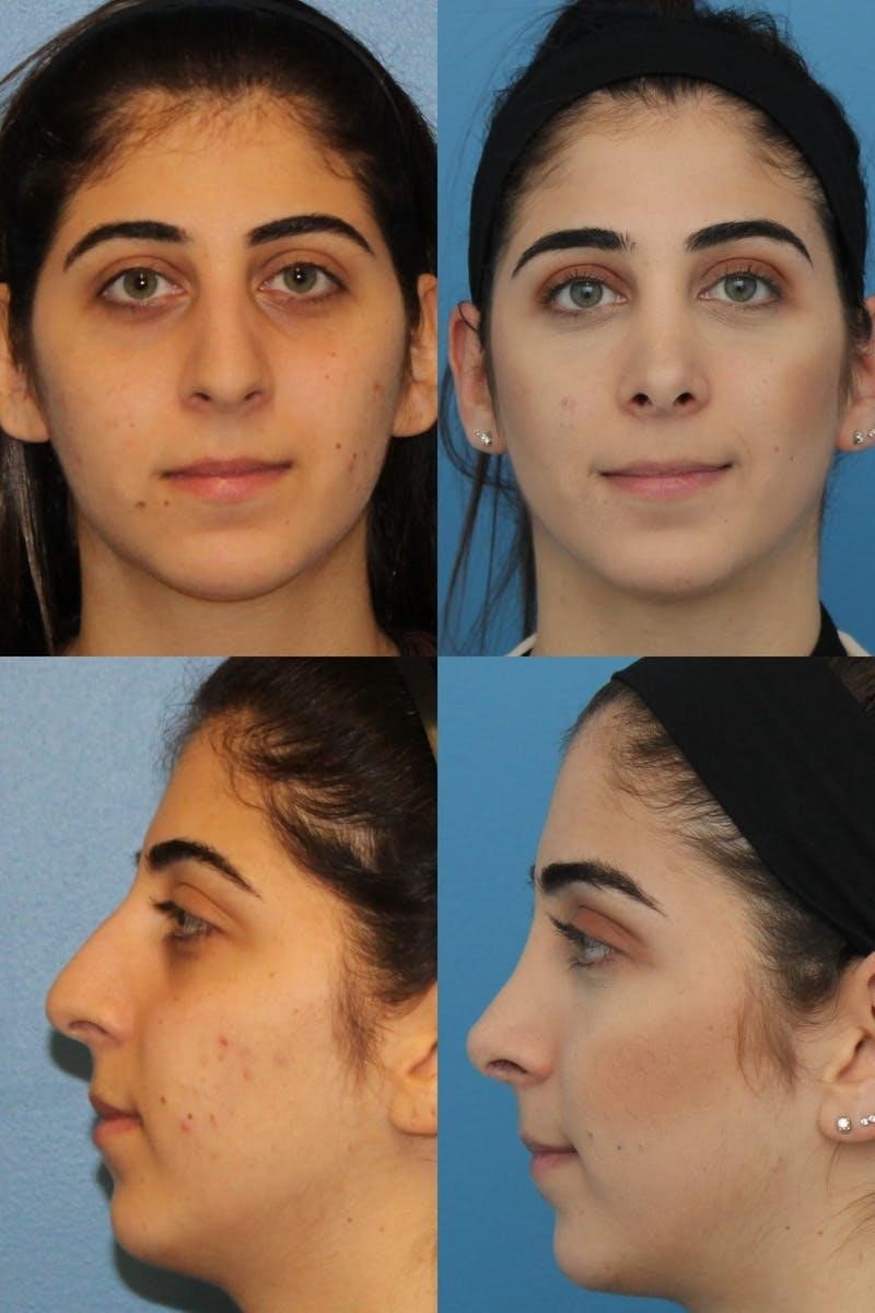closed rhinoplasty recovery