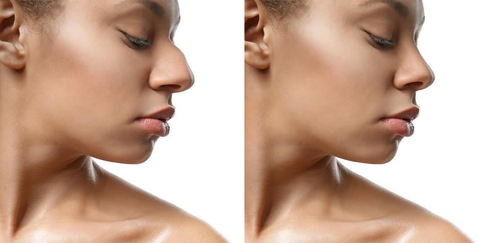 thick skin rhinoplasty expert