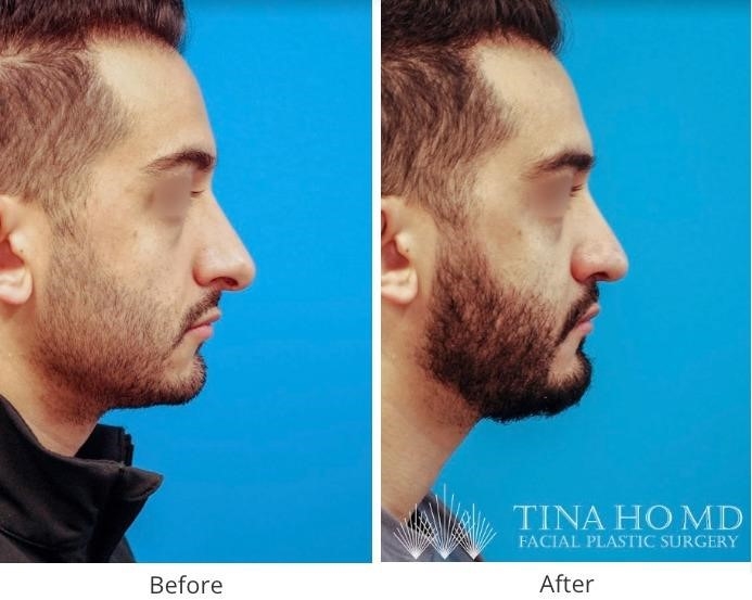 thick skin rhinoplasty expert