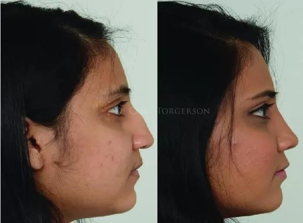 thick skin rhinoplasty expert