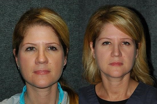 thick skin rhinoplasty expert