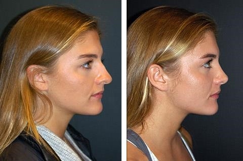 closed rhinoplasty recovery