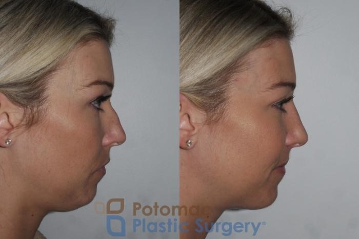 closed rhinoplasty recovery